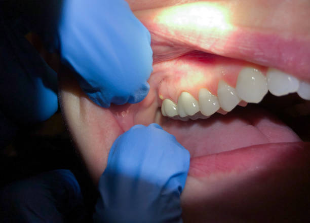 Best Emergency Denture Repair in Laureldale, PA